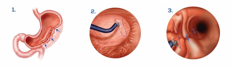 Chirurgie de l'obésité par Sleeve Endoscopique à Nice dans les Alpes maritimes